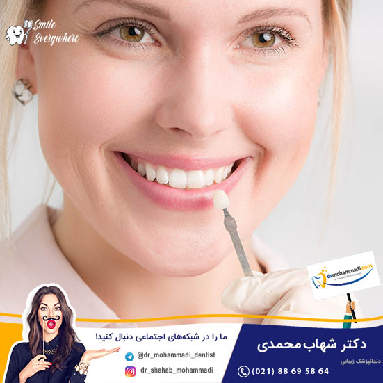  کامپوزیت ونیر باعث پوسیدگی دندان میشود؟ - کلینیک دندانپزشکی دکتر شهاب محمدی